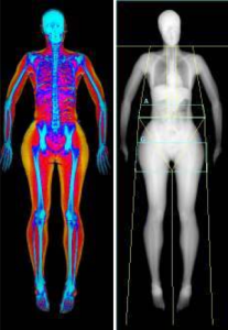 dexa scan